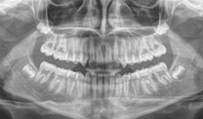 X-Ray of smile after creating space for impacted teeth through orthodontic treatment