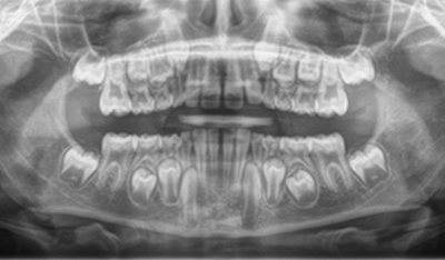 X-Ray of smile with impacted teeth