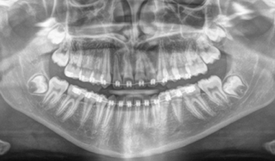 Panoramic x-rays of smile after creating space for impacted teeth through orthodontics