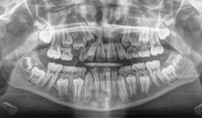 Panoramic x-ray of smile with numerous impacted teeth