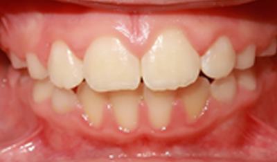Closeup of smile with corrected spacing after orthodontic treatment