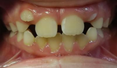Closeup of smile with uneven spacing before orthodontic treatment