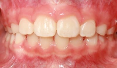 Closeup of perfectly spaced front teeth after orthodontic treatment