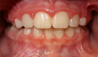 Closeup of smile with closed bite after orthodontic treatment