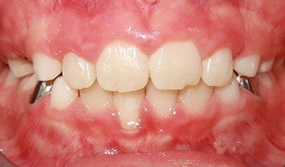 Closeup of corrected smile after orthodontic treatment for crossbite