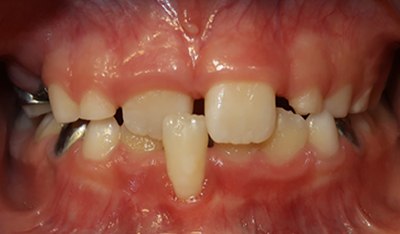 Closeup of smile with crossbite