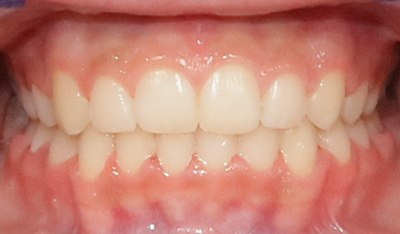 Closeup of correctly aligned smile after orthodontic treatment for overbite