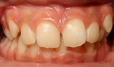 Closeup of smile with overbite