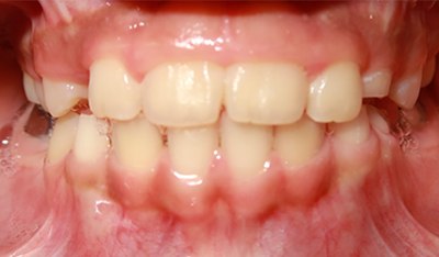 Closeup of perfected smile after orthodontic treatment for underbite