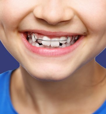 Smiling child with interception orthodontics appliance in place