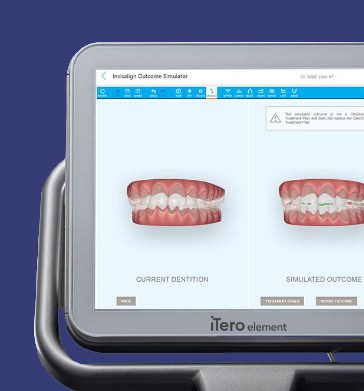 The iTero orthodontic treatment planning system