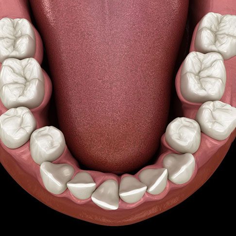 3D illustration of teeth overcrowding 