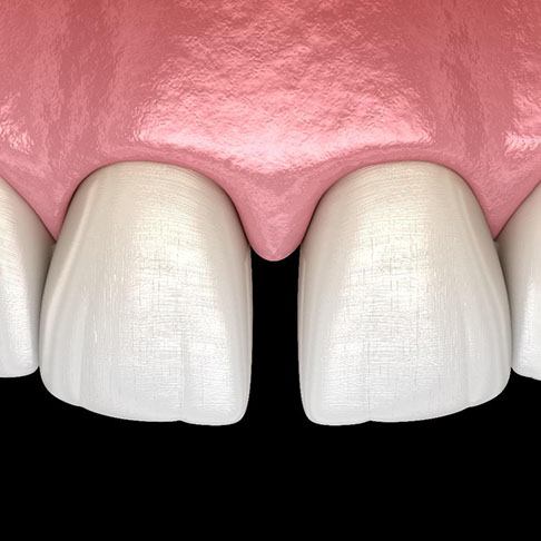3D illustration of gapped teeth 