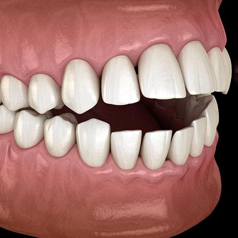 3D illustration of open bite