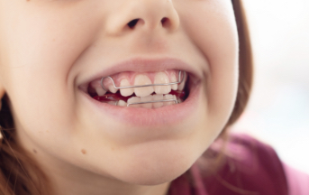 Closeup of child's smiel with interceptive orthodontics appliance