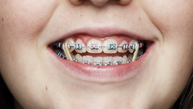 Close-up of teenager’s smile with rubber bands and braces