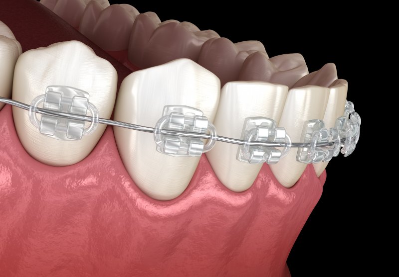 digital image of braces on lower teeth