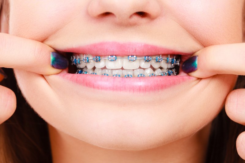 person with full set of braces