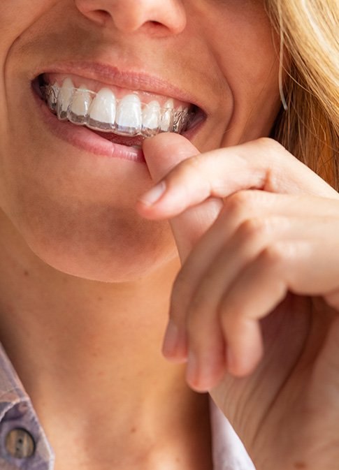 adult-braces-1